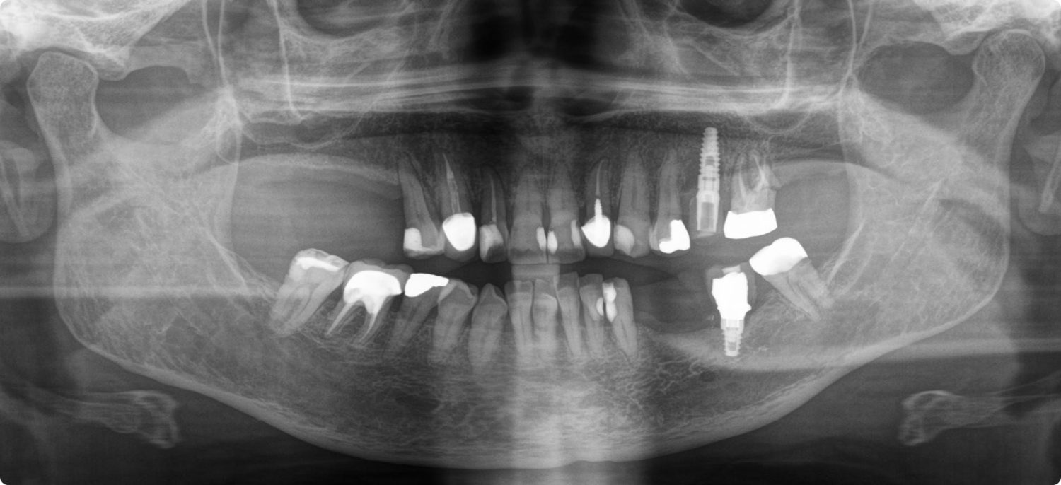 An X-ray of a women's teeth with some of her teeth missing