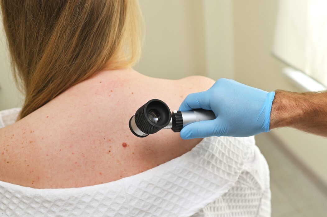 A woman wearing a hospital gown with the top of her back exposed. A doctor is inspecting a mole on her back with a magnifying tool.