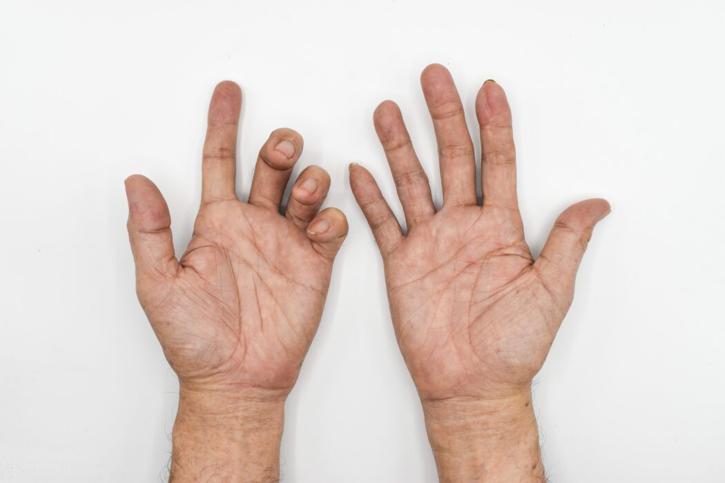 A pair of hands on a blank background. The hand on the left is contracting due to nerve damage.